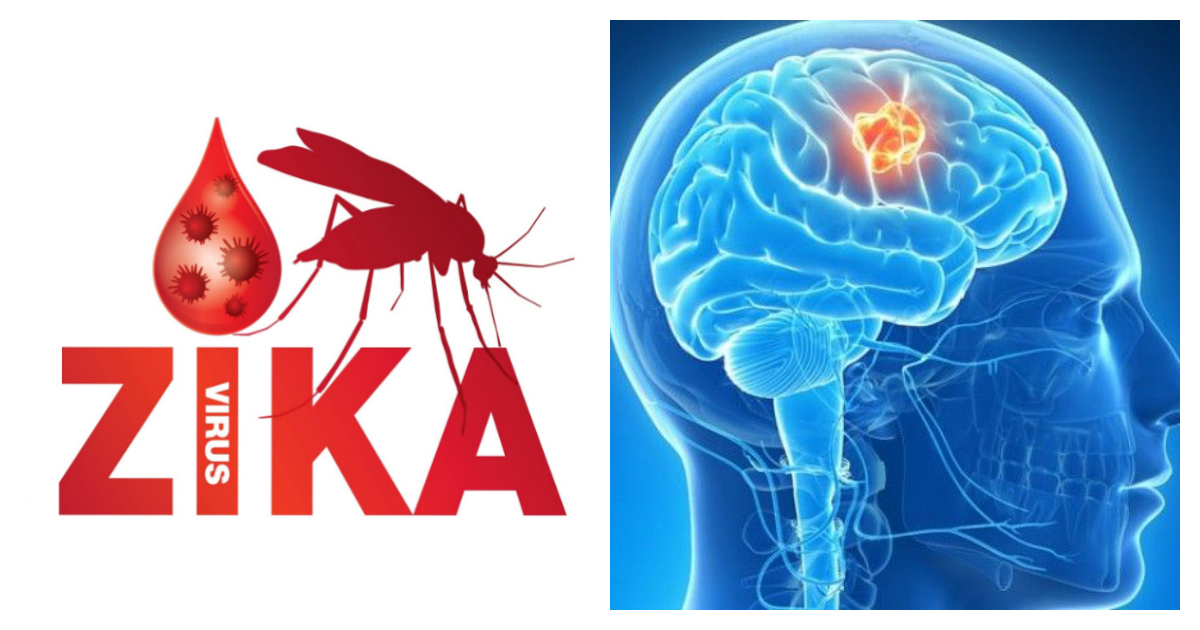 El virus del Zika podría ser la cura para los tumores cerebrales