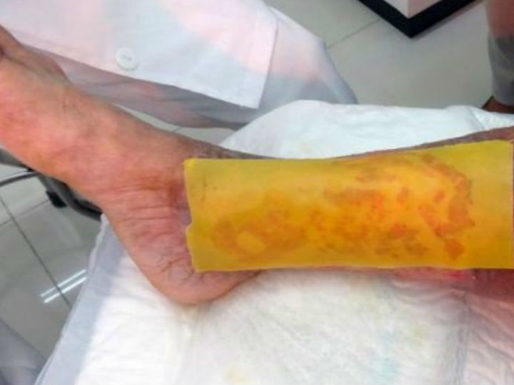 Científicos de la UNAM crean parche que cura el pie diabético en tiempo récord