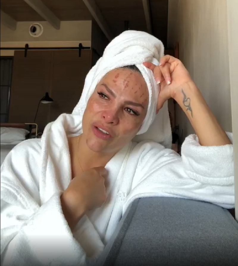 Fabiola Campomanes se quema la cara por exceso de tratamientos