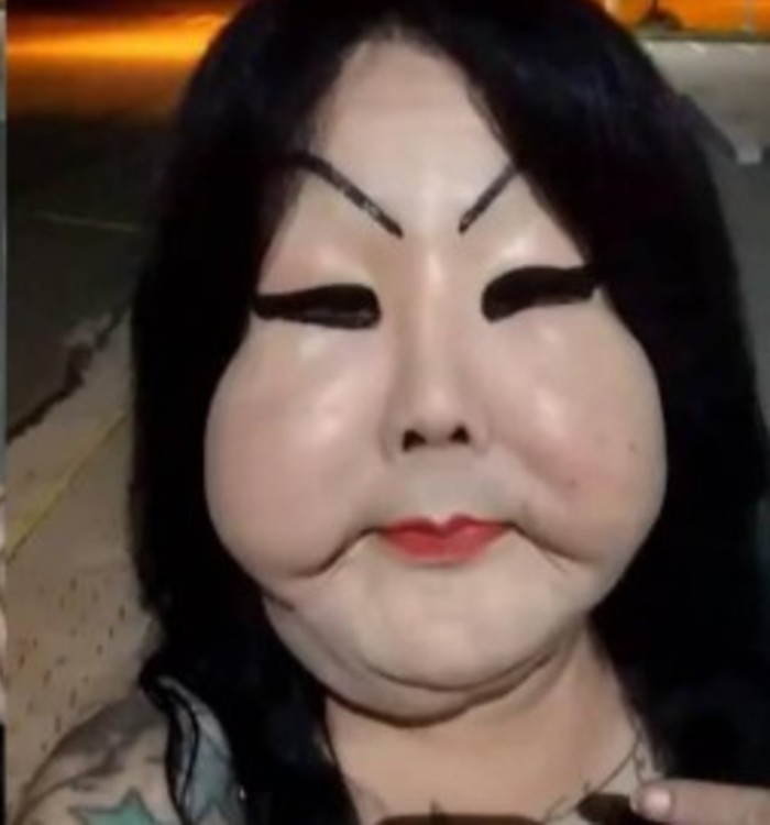 Mujer trans se inyectó silicona industrial y le deformó la cara