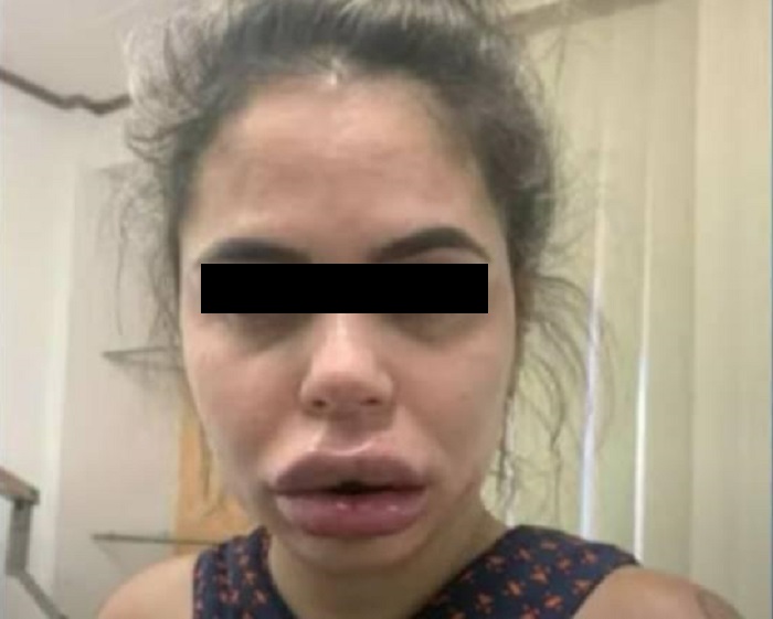 Dentista que hacía cirugías estéticas le deformó la cara a sus pacientes