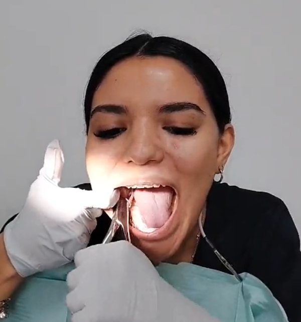 Dentista se extrae sola las muelas del juicio para promocionarse