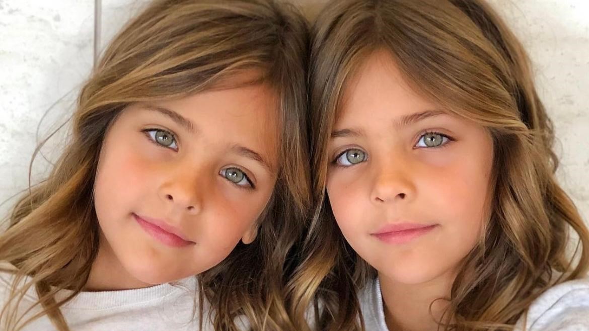 Así lucen ahora las gemelas "más hermosas del mundo"